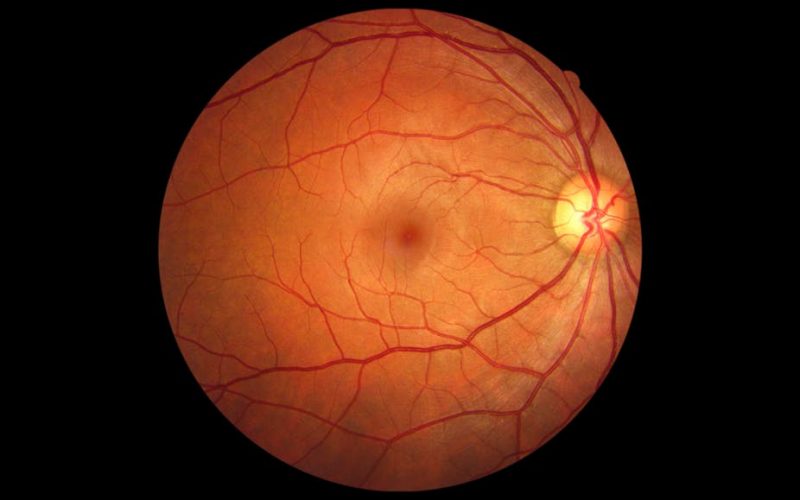 polo oculistico emiliano distacco retina 2